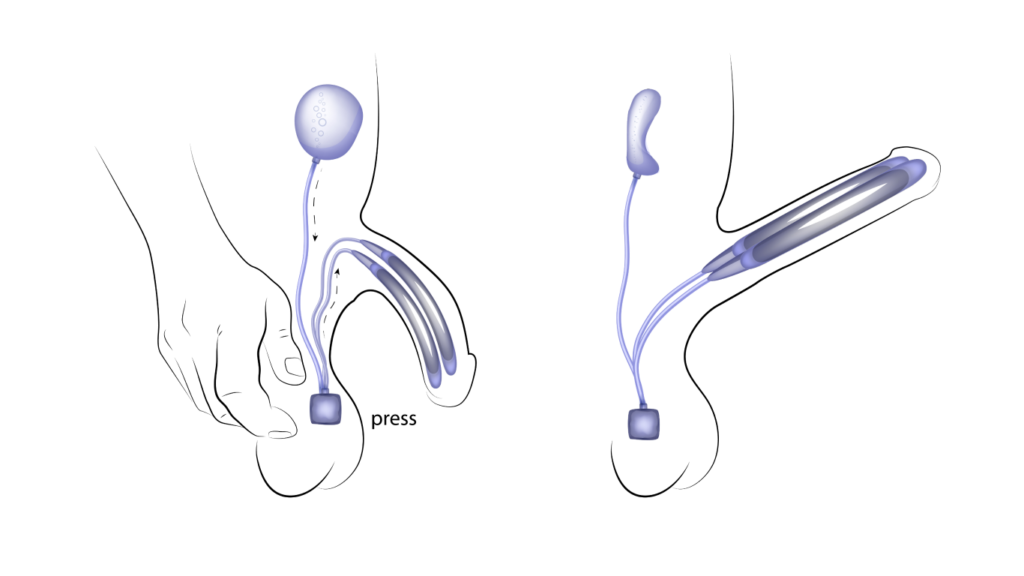 Prótese peniana implantada no pênis