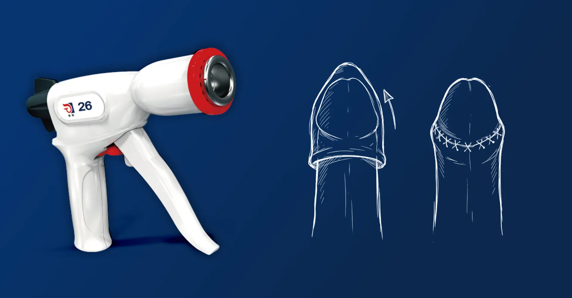 Postectomia afeta a sensibilidade