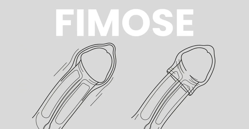 Fimose em adultos: entenda os tratamentos disponíveis e os problemas de não tratar