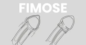 Fimose em adultos: entenda os tratamentos disponíveis e os problemas de não tratar