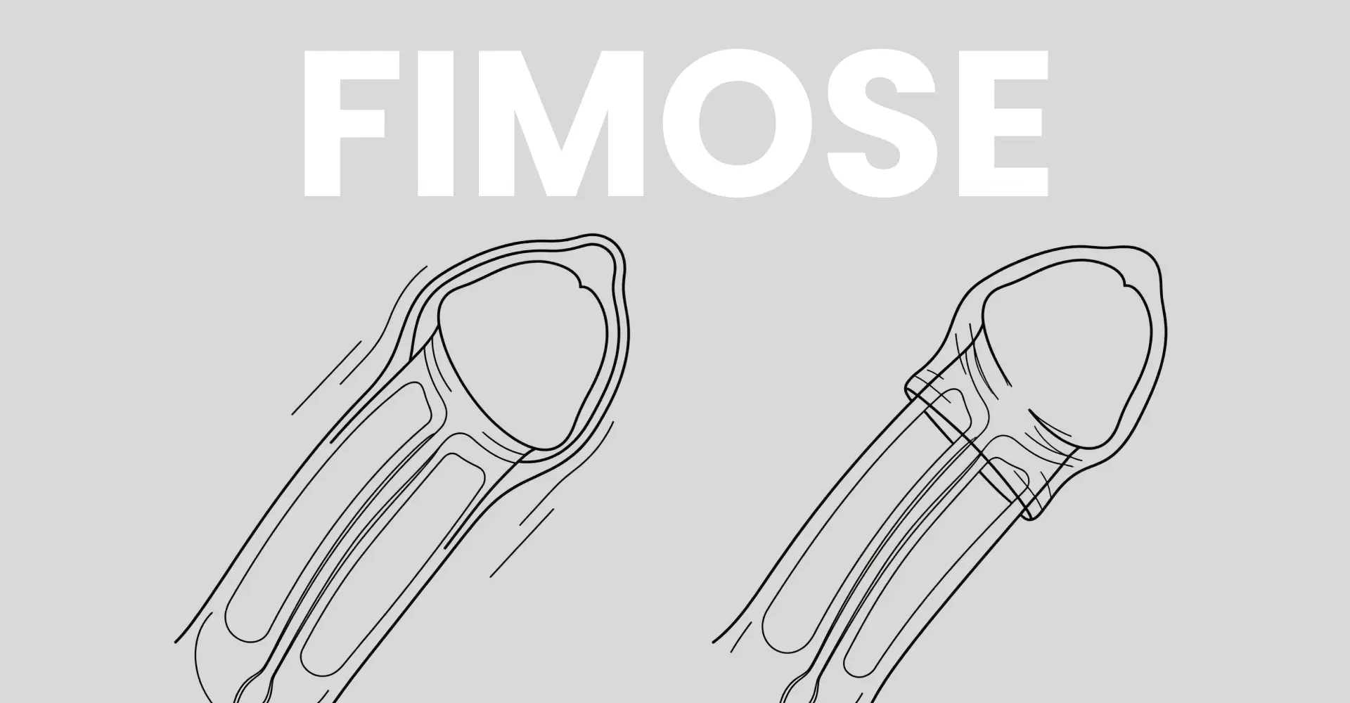 Fimose em adultos: entenda os tratamentos disponíveis e os problemas de não tratar